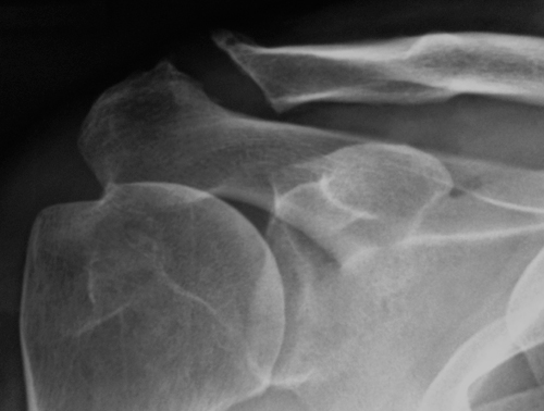 What Is AC Joint Arthritis?