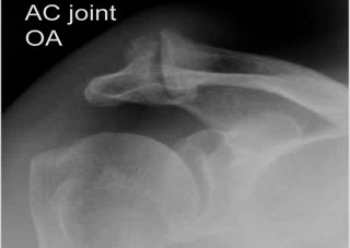 udslettelse knude Hofte AC Joint Arthritis Sydney | Acromioclavicular Arthrosis NSW | Australia