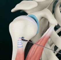 Biceps Tenodesis